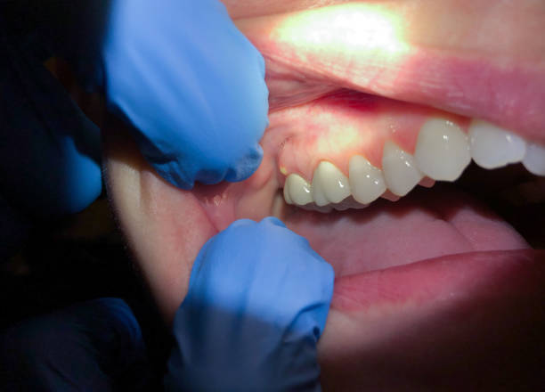 Best Chipped Tooth Repair Near Me  in Watseka, IL